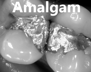 amalgam fillings